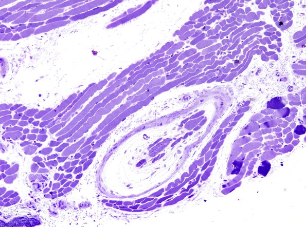 2B1A Muscle spindle (Case 8) Plastic 1