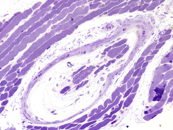 2B1B Muscle spindle (Case 8) Plastic 2