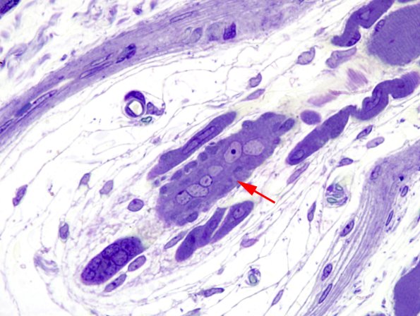 2B1C Muscle spindle (Case 8) Plastic 3 copy