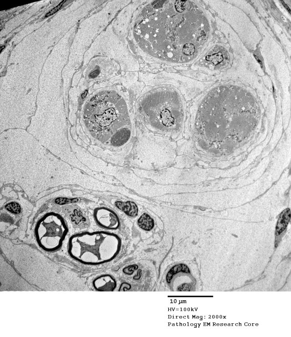 3A1 Muscle Spindle (Case 9) EM 020 - Copy