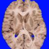 1A1 Normal Brain, Adult, CT Cut (Case 1) 2