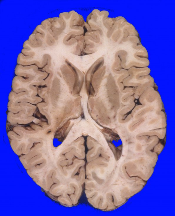 1A1 Normal Brain, Adult, CT Cut (Case 1) 2