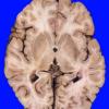 1A2 Normal Brain, Adult, CT Cut (Case 1) 4