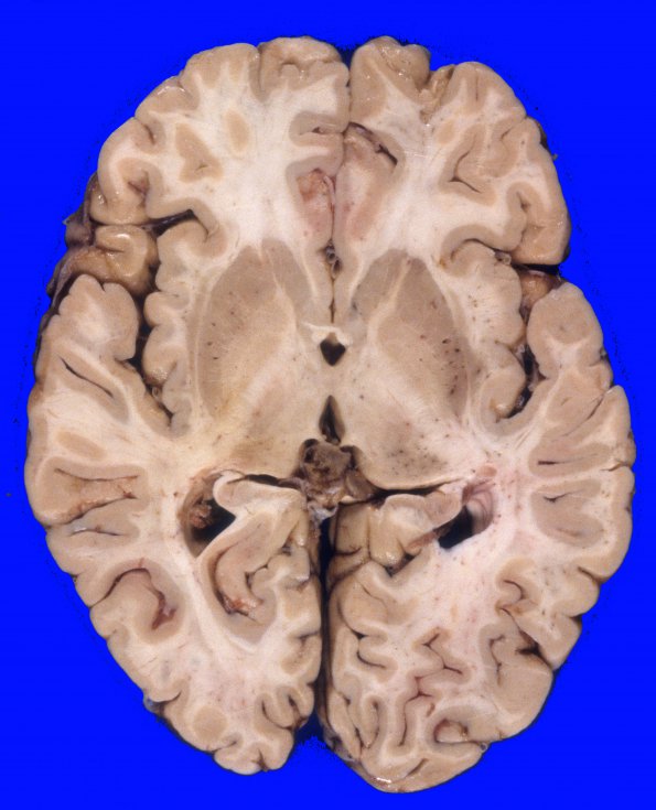 1A2 Normal Brain, Adult, CT Cut (Case 1) 4