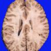 1A3 Normal Brain, Adult, CT Cut (Case 1) 5