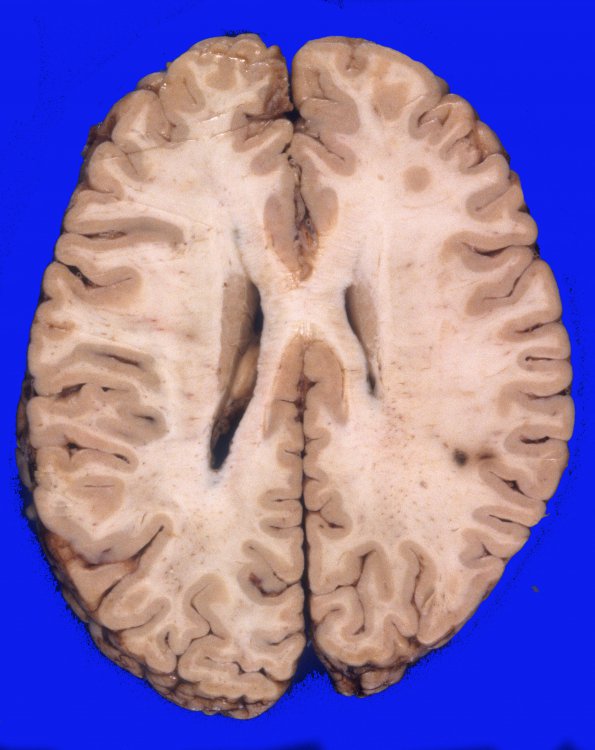 1A3 Normal Brain, Adult, CT Cut (Case 1) 5