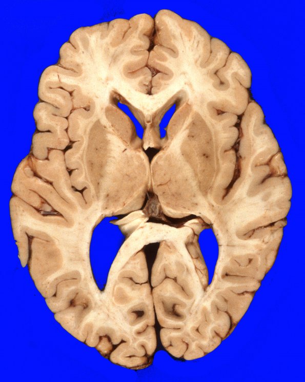 2 Normal Brain, CT cut (Case 2) Gross 2