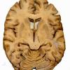 Normal Adult Brain - Axial (CT) Cut