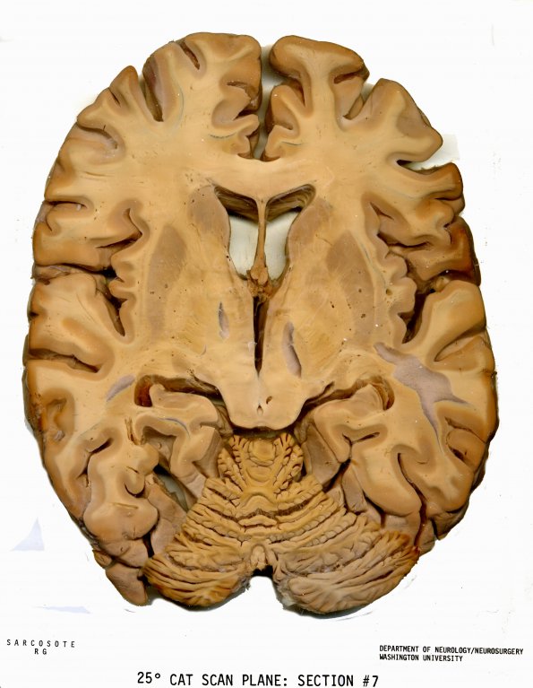 3 CAT SCAN PLANE Section - 7 (Case 3)