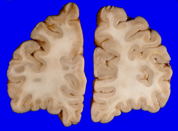 1A Brain, coronal, Section 1