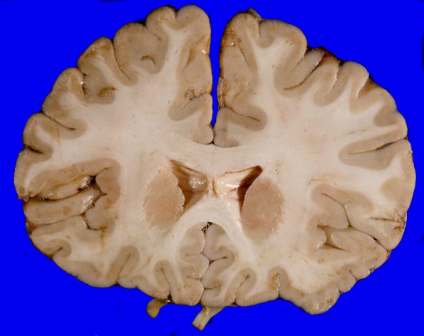 1B Brain, coronal, Section 2