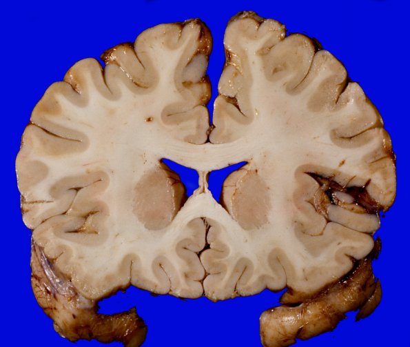 1C Brain, coronal, Section 4