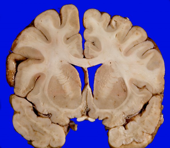 1D1 Brain, coronal, Section 5