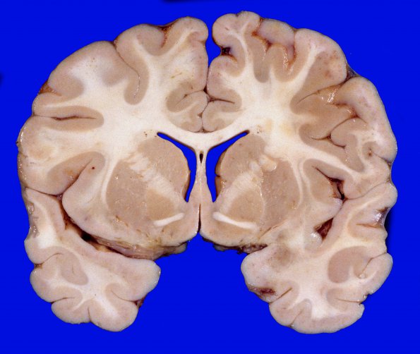 1D2 Normal Adult Brain (Case 1) 3