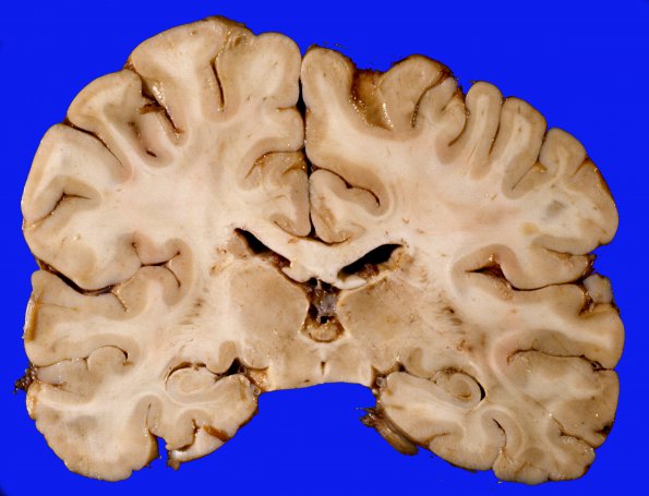 1F1 Brain, coronal, Section 7