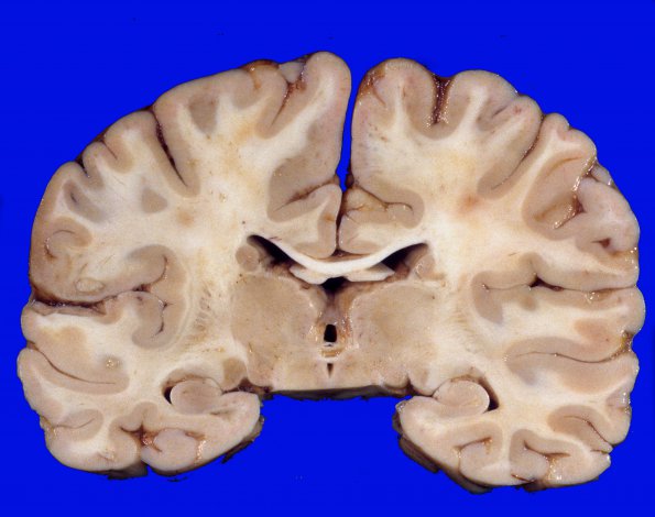 1F2 Normal Adult Brain (Case 1) 2