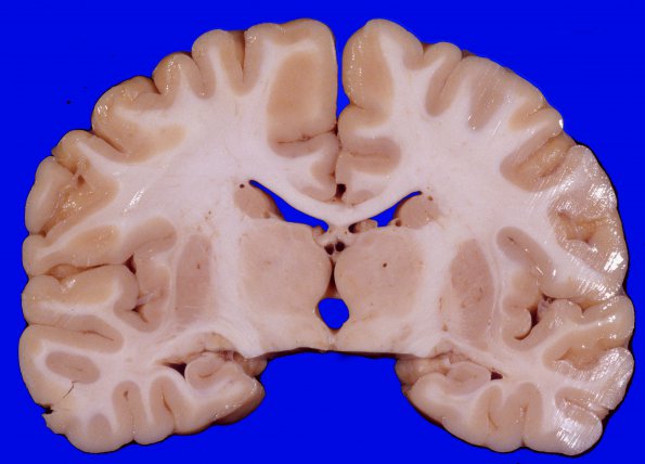 1F3 Normal Brain (Case 2 A41346) 3