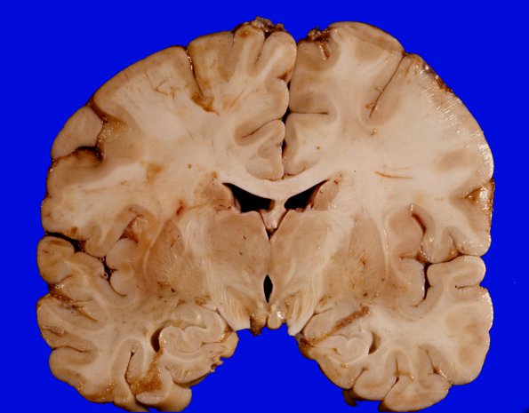 1G1 Brain, coronal, Section 8 (2)