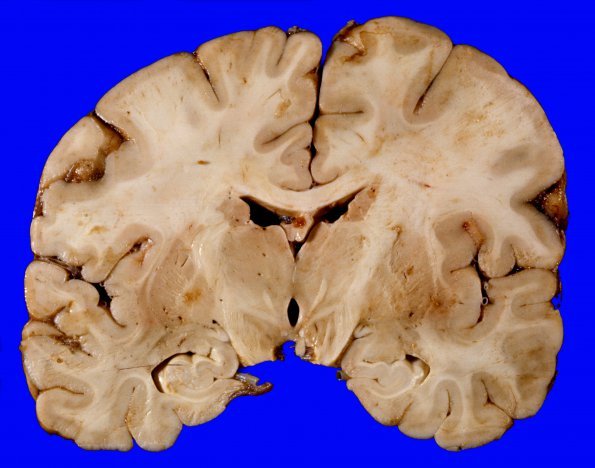 1G2 Brain, coronal, Section 8