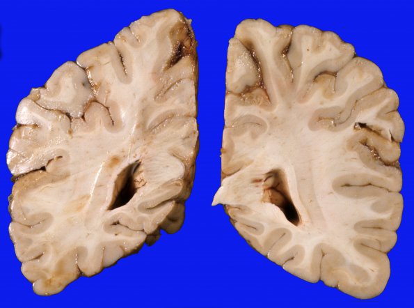 1H Brain, coronal, Section 9