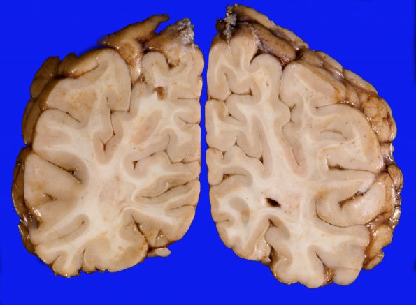 1I Brain, coronal, Section 10