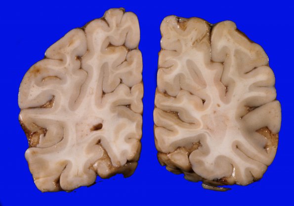 1J Brain, coronal, Section 11