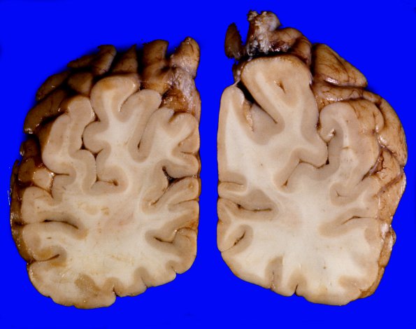 1K Brain, coronal, Section 12