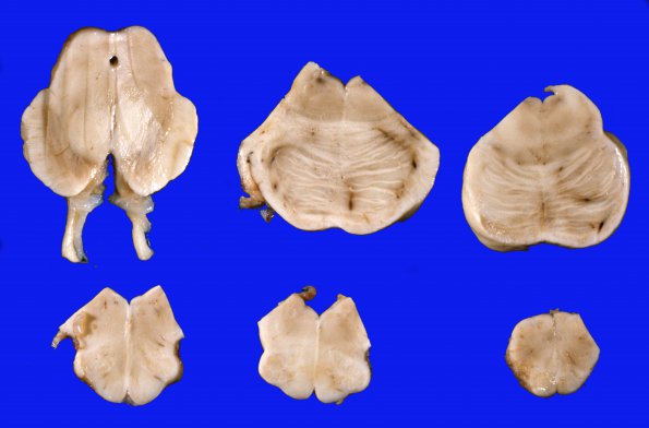 2A Brainstem, normal Section 13