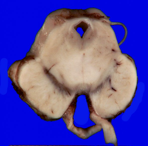 2B Brainstem, normal (Case 3) Gross _2