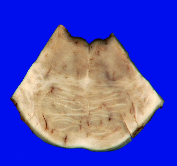 2D Brainstem, normal (Case 3) Gross _4