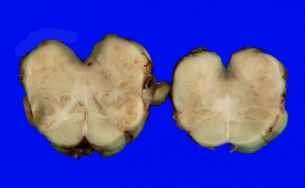 2E Brainstem, normal (Case 3) Gross 5