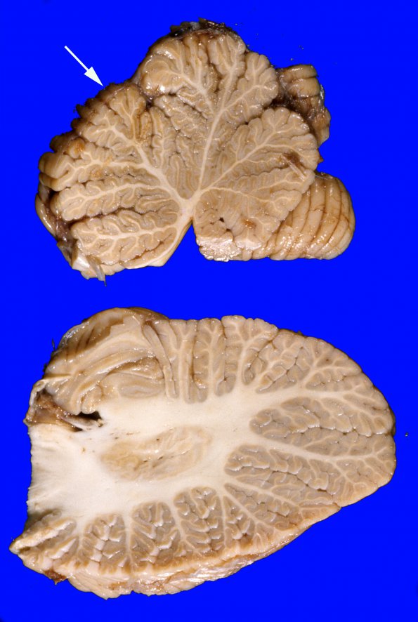 4A Cerebellum, normal - Hemisphere & Vermis Section 15 copy