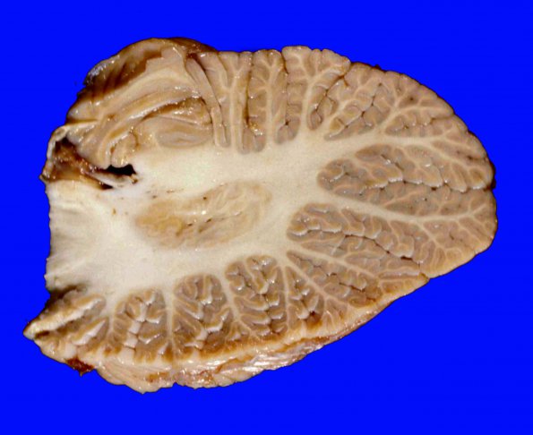 4B1 Cerebellum, normal - Hemisphere