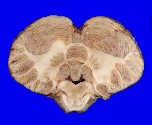 5A Brainstem & Cerebellum (Case 1) 1