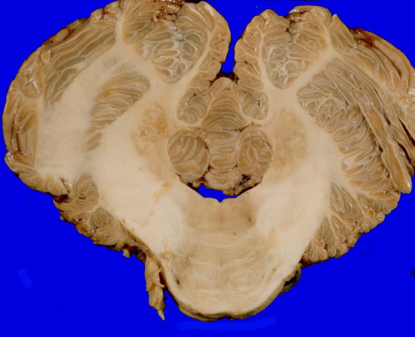 5B Brainstem & Cerebellum (Case 5) 11