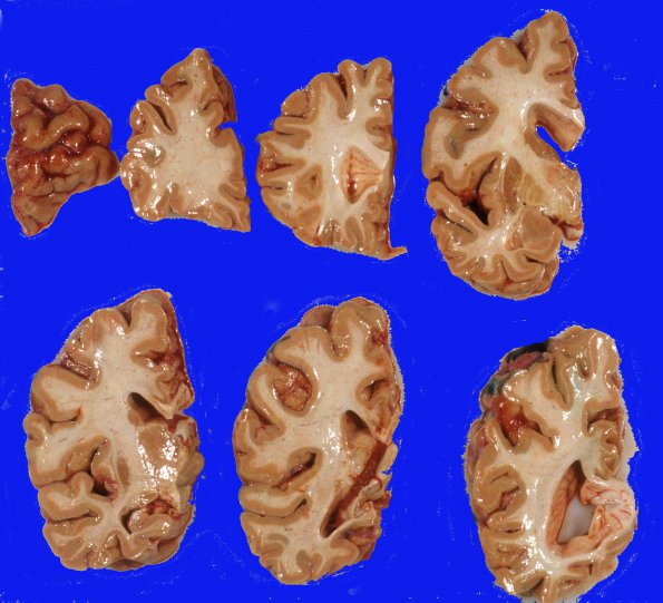 6A Brain, normal, unfixed, cut fresh (Case 6) 1