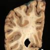1A1 Striate cortex, normal (Case 1) Gross_2 copy