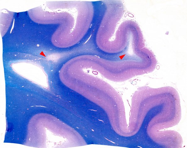 5 Striate Cortex (Case 5) MS copy