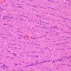 1A5 Oligodendroglia, exaggerated (Case 2) H&E 1