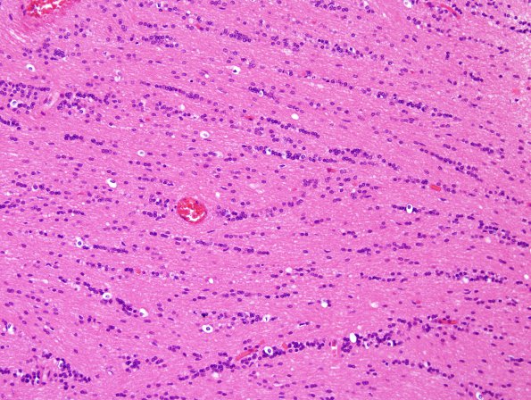 1A5 Oligodendroglia, exaggerated (Case 2) H&E 1