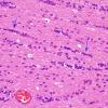 1A6 Oligodendroglia, exaggerated (Case 2) H&E 2 copy