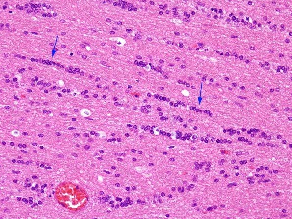 1A6 Oligodendroglia, exaggerated (Case 2) H&E 2 copy