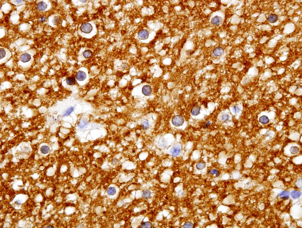 1B3 Myelin, (Neuroaxonal Leukodystrophy (POLD,HDLS) CNPase 1