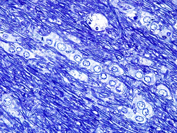 1C2 Oligodendroglia (Case 3) Pons Plastic 35