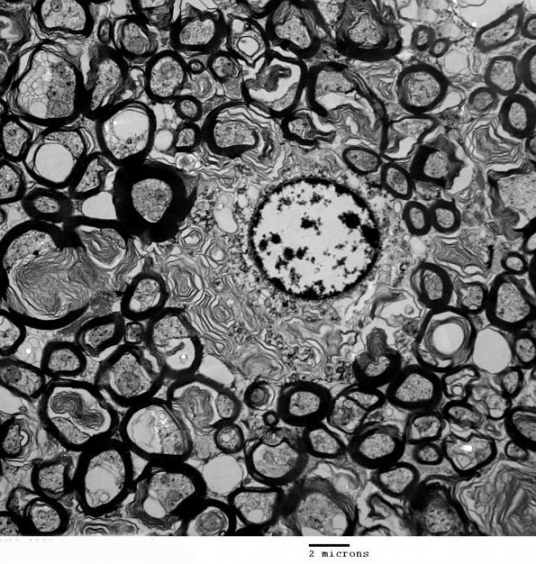 1D1 Oligodendroglia (Case 3) EM 032 - Copy