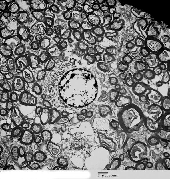 1D2 Oligodendroglia (Case 3) EM 022 - Copy