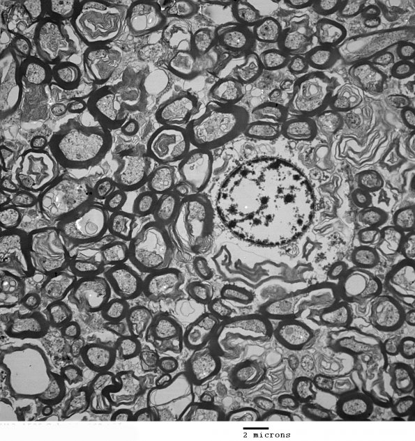 1D3 Oligodendroglia (Case 3) EM 063 - Copy