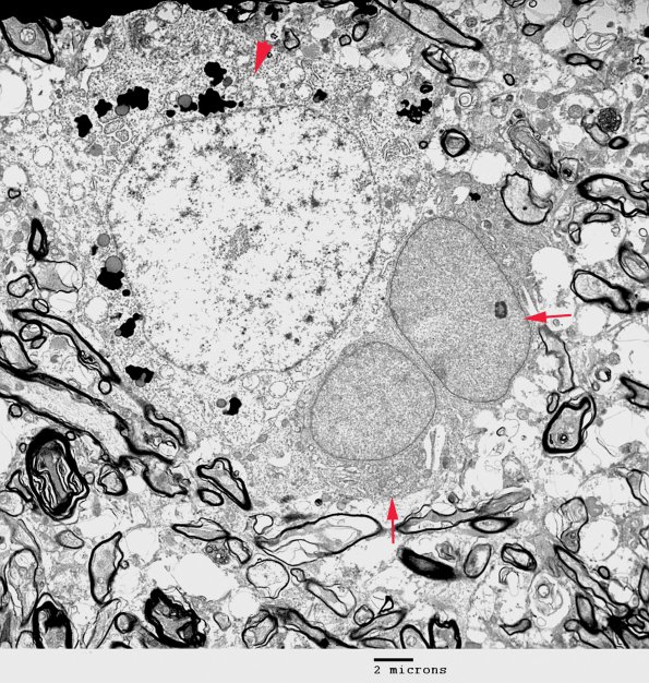 1F1 Oligodendroglia, satelliting (Case 5) EM 4 - Copy copy