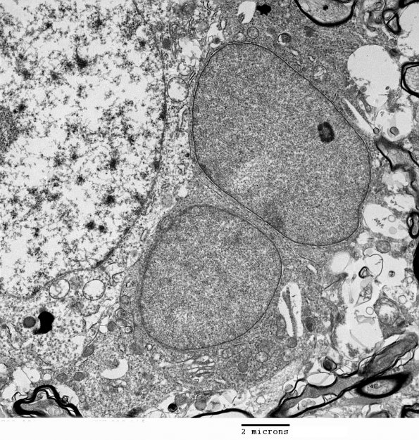 1F2 Oligodendroglia, satelliting (Case 5) EM 3 - Copy