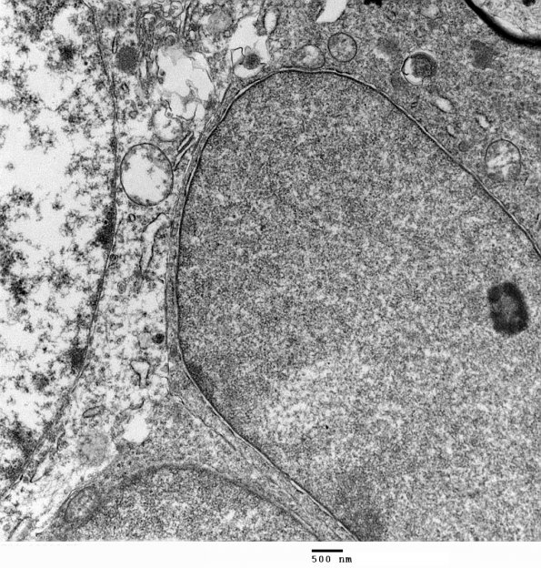 1F3 Oligodendroglia, satelliting (Case 5) EM 2 - Copy